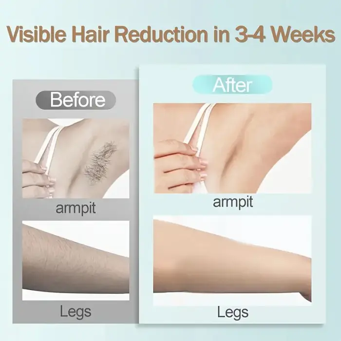 At-Home IPL Hair Removal Device - Lasting Results - Image 4